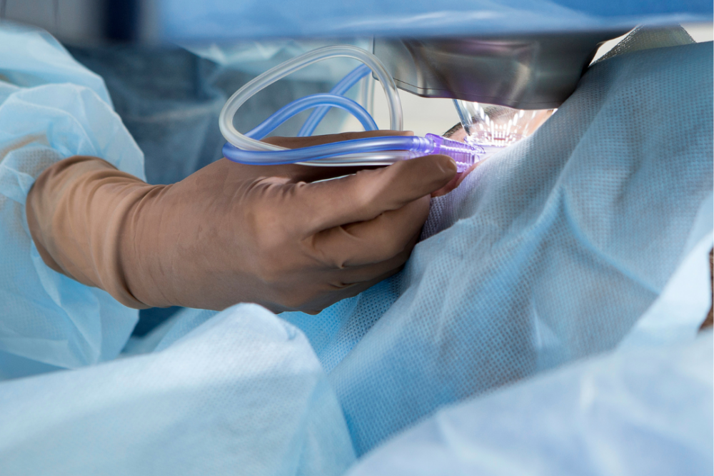 LASIK Eye Surgery